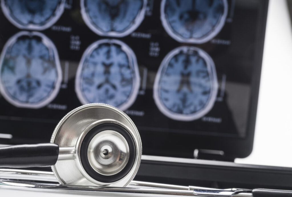 Un mecanism natural din creier, care favorizează eliminarea plăcilor toxice implicate în Alzheimer, identificat de oamenii de ştiinţă